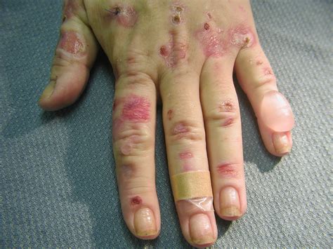 How To Heal Hand Blisters - Behalfessay9
