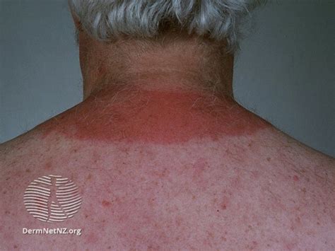 Itchy red rash after sun exposure | OnMedica