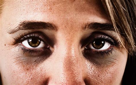 Can Sunken Eyes Be a Sign of Something Serious?