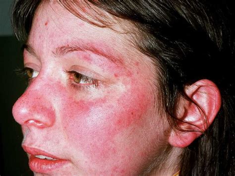 systemic lupus erythematosus article