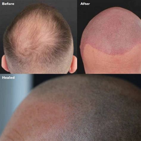 ALOPECIA: SYMPTOMS, CAUSES AND CORRECTION – AZPMU