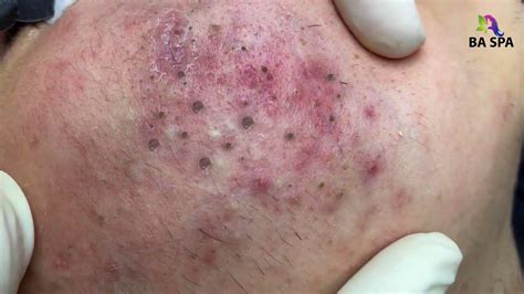 blackhead pimple popping    spa  kevin christensen blog