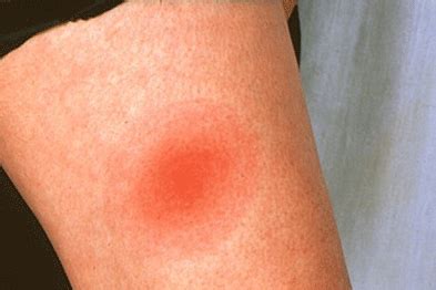 lyme disease gponline