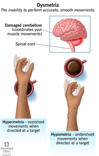 Approach to ataxia and vestibular disease Flashcards | Quizlet