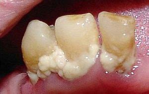 plaque definition  plaque