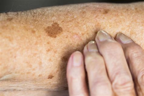 Skin Discoloration: Causes and Treatments