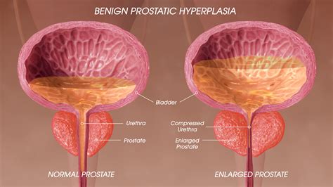 BENIGN PROSTATIC HYPERPLASIA: Symptoms, Causes, and treatment ...