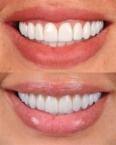 substituição de lentes. - ela não estava feliz com suas lentes, sentia