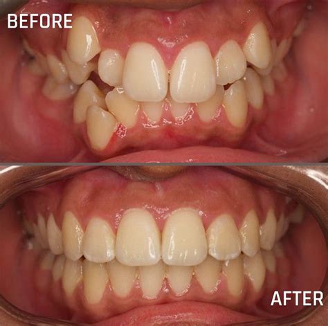 orthodontic treatment crowding teeth  johnny sanderson blog