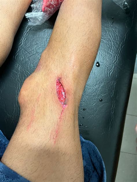 Durísimo: así le quedó la pierna a Laso en la jugada del penal a Lanús