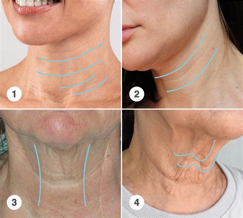 falten  hals entfernen halsstraffung das muessen sie wissen