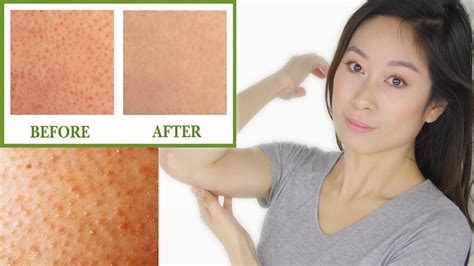 Keratosis Pilaris Treatment Bumps On Skin Chicken Skin