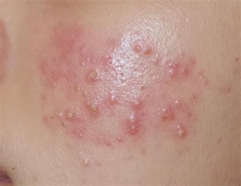 acne pustules