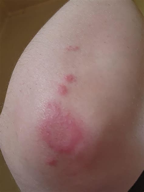 Red rash on elbow : r/medical_advice