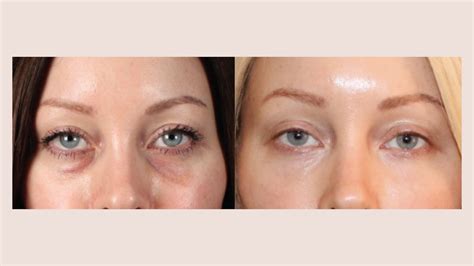 Reveal Radiant Eyes with PRP/PRF Injections at Colorado Beauty RN ...