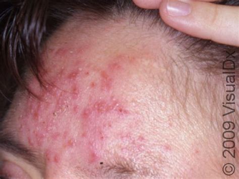 rosacea acne
