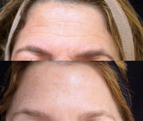 Before & After Photos Wrinkle & Line Reduction | NYC