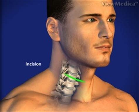 cervical corpectomy orthopaedic surgeon spine surgery myrtle beach