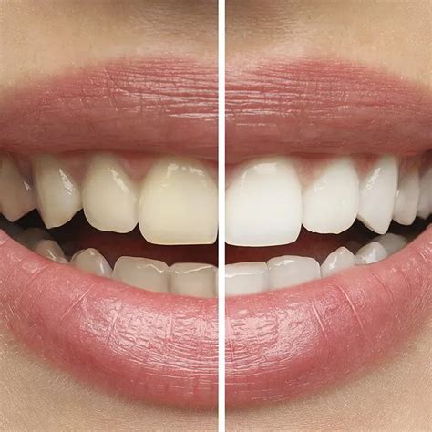 O Que É Branqueamento - Branqueamento Dentário - João Andrade Clínica