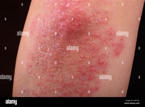 macro psoriasis  res stock photography  images alamy