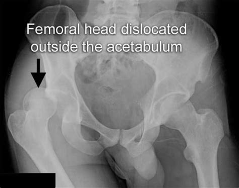 Traumatic hip dislocation - Hip and Knee clinic