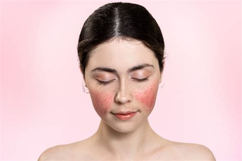 Rosacea Symptoms | Pinnacle Dermatology | Beaufort, SC