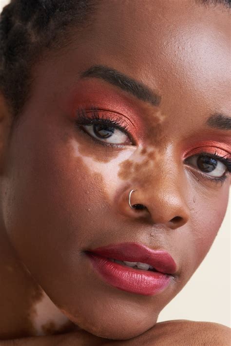 vitiligo skin condition   treatments ps beauty
