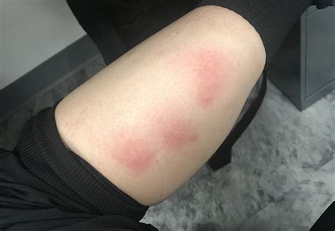 Carpet Beetle Larvae Skin Reaction Carpet Beetle Extermination | Las