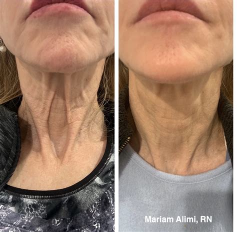 A Complete Guide To Microneedling Including Before An - vrogue.co