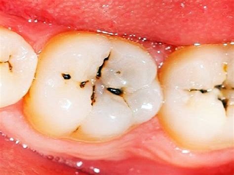 dental cavities dental cavities  treatment options adedejiofakure