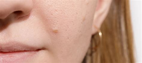 dry  greasy skin meaning  treatment  dry  oily skin