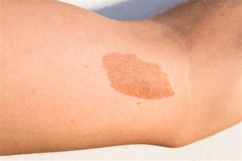 Birthmark removal | SILKOR UAE
