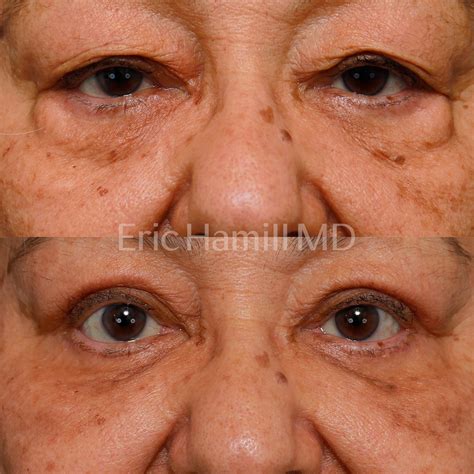 how to fix a droopy eyelid