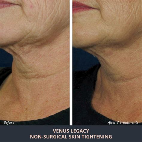 Radio Frequency Skin Tightening - Novuskin