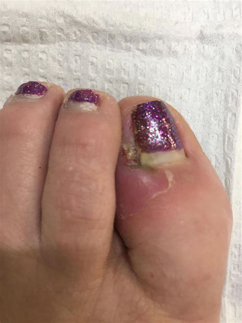 Infected Toe