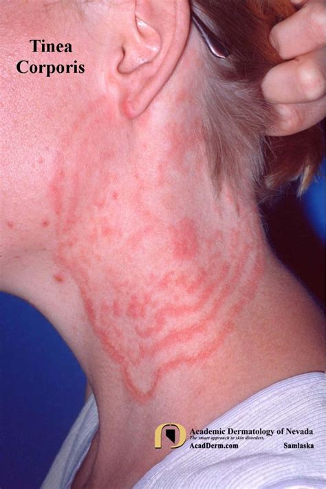 tinea corporis medikamente tinea pedis fkgi