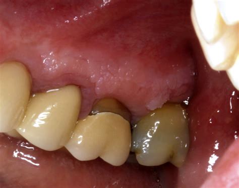 Mild Leukoplakia Gums Leukoplakia American Osteopathic College Of