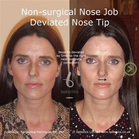 Nose Job Definition at Phillip Dorsey blog
