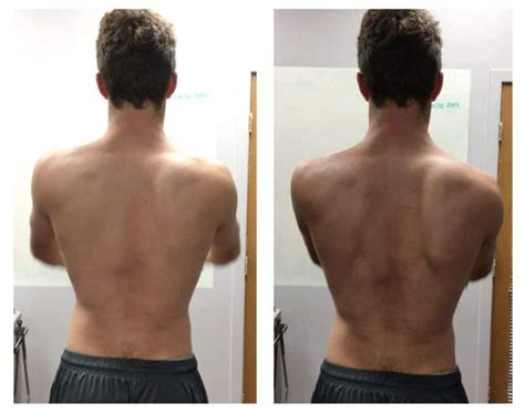 Assessing Dynamic Shoulder Mobility and Scapular Dyskinesis | Scapular ...
