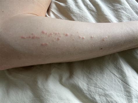 Small red bumps on forearm : r/DiagnoseMe