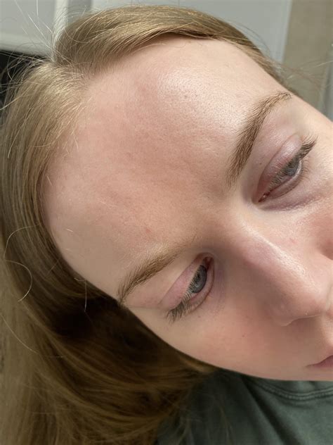 57 best r/scleroderma images on Pholder | This is making me miserable