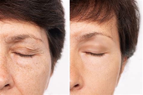 Maximizing Scar Healing After Eyelid Surgery