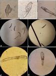 prevalence  demodex folliculorum  demodex brevis  patients