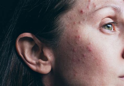 Pimples