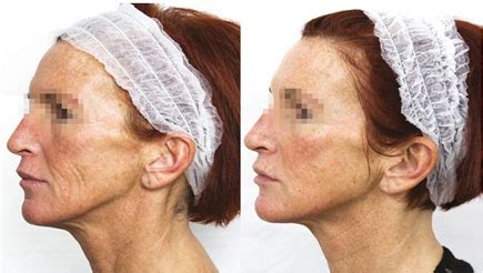 PRX-T33 biorevitalizing peel in Monaco - Dr Antoni