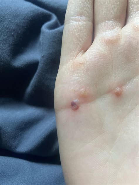 Freezing wart complication? : r/medical
