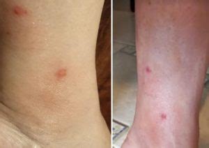 Picada De Mutuca Como Fica - Picada de Butuca pode Inflamar – Sintomas e Cuidados com Mutucas