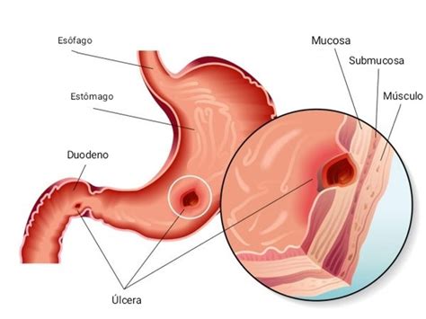 O'que É Ulcera No Estomago