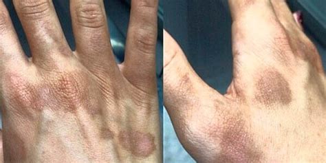 Manchas Marrom Na Palma Da Mão - Tratamento para Manchas • Dermatologista Flávia Freitas • Belo Horizonte