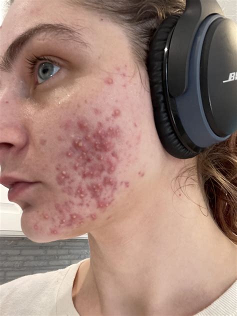 Severe hormonal acne while pregnant : r/acne